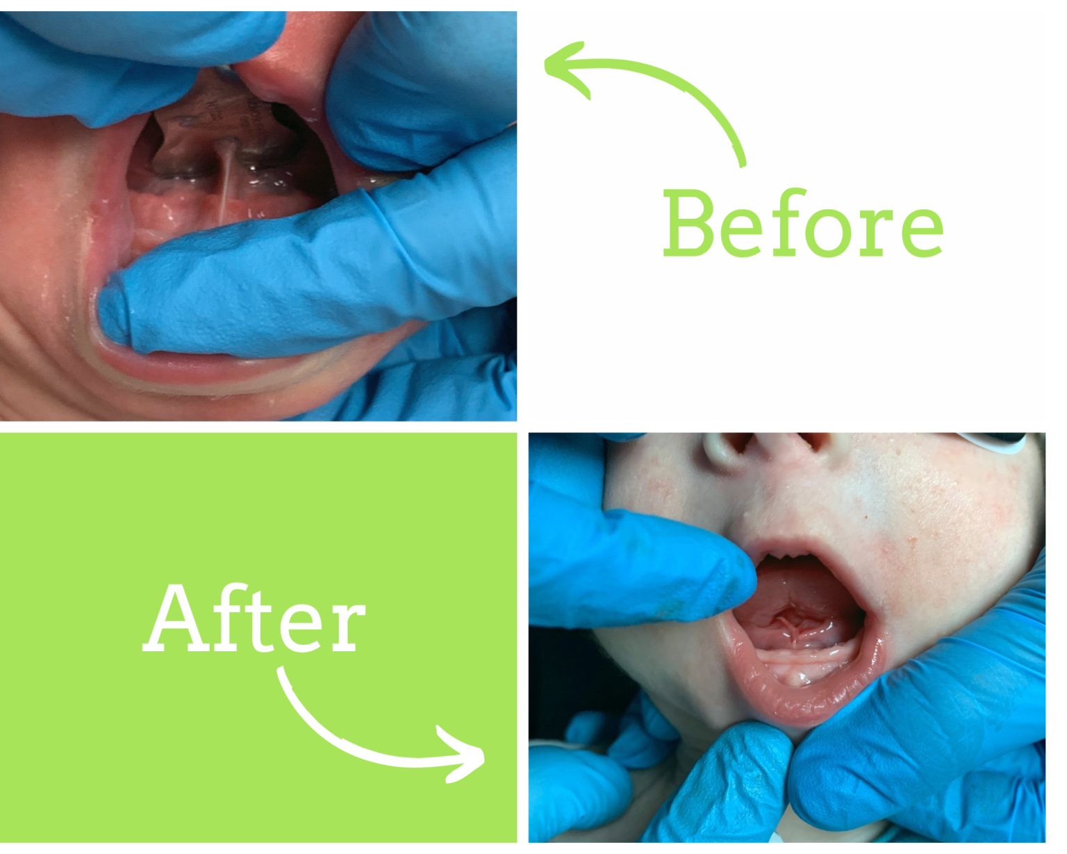 Frenulectomy (Tongue-Tie and Lip-Tie Release) - Atlanta Pediatric